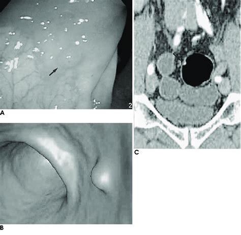 Images in a 56-year-old man with 5-mm polyp in sigmoid colon. A.... | Download Scientific Diagram