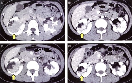 Axial contrast-enhanced CT scan of the kidney. (a) Before treatment;... | Download Scientific ...