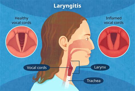 Tonsils Throat Diseases Laryngitis Symptoms Treatment Icon, 52% OFF