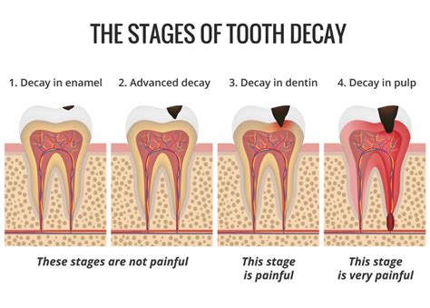 Five Ways to Reduce Your Risk of Tooth Decay - Dental on Martyn