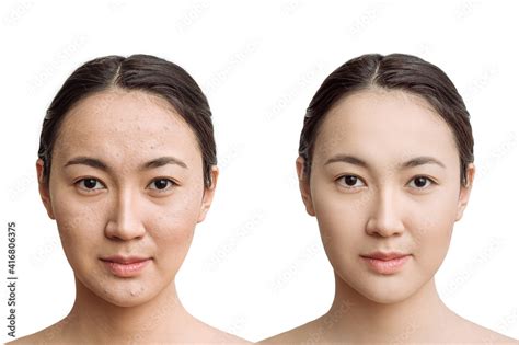 the concept of skin care before, after. young asian woman with bad skin with wrinkles and acne ...