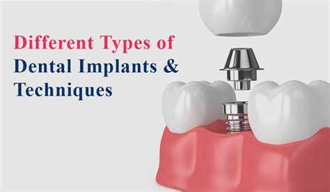 Dental Implants: Types of Implants and Who They're for - Peak Mens Health