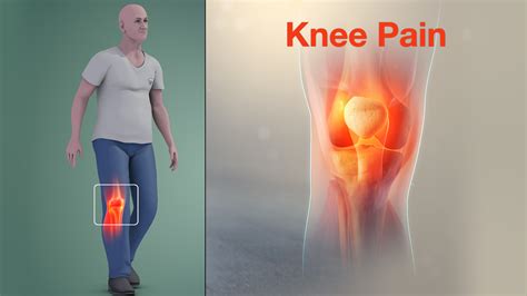 Knee Pain Causes Signs Symptoms Diagnosis And Treatment Hot Sex Picture | The Best Porn Website