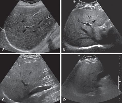 Conventional ultrasound findings in chronic liver disease | Radiology Key