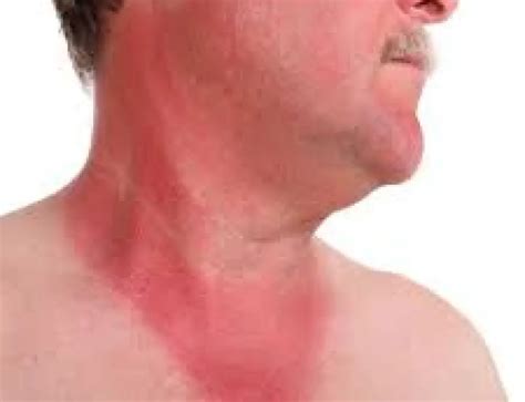 Sun Poisoning on Face – How to Treat Swollen, Blisters from Sun Poisoning on Face