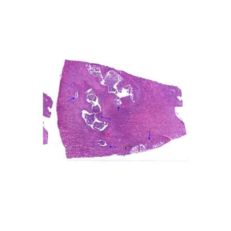 75 mm x 25 mm x 1.2 mm Pathology - Pyonephrosis Kidney Microscope Slide ...