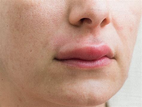 Swollen upper lip: Causes and treatments