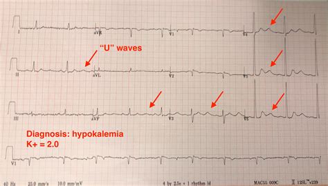 ECG Electrocardiogram