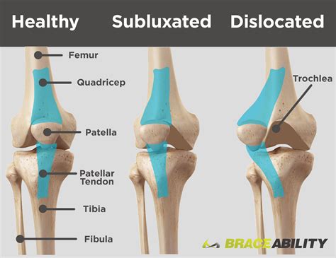 Patellar Subluxation (Partially Dislocated Kneecap) | Subluxation, Knee pain, Knee exercises