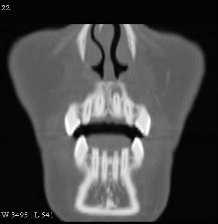 Periapical cyst | Radiology Reference Article | Radiopaedia.org