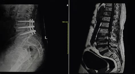 Faster Spinal Fusion Recovery - What Steps to Make?