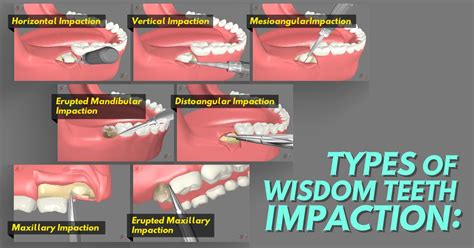 Types of wisdom teeth impaction: - Horizontal impaction - Vertical ...