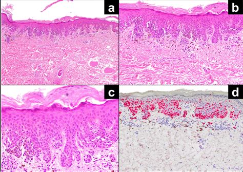 The final diagnosis was a dysplastic compound nevus with severe atypia ...