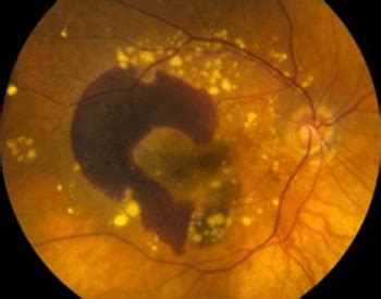 Differential Diagnosis of Blurred Vision