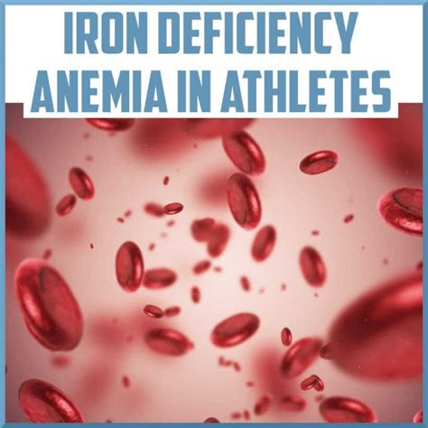 Iron Deficiency Anemia in Athletes - Sports Medicine Review