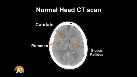 Ct Scan Brain Anatomy Anatomy Of Head Ct Scan Normal The Brain On Ct ...