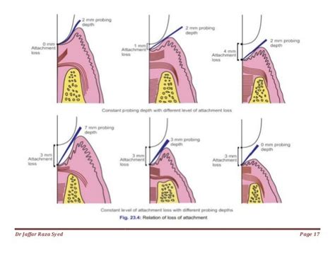 023.periodontal pocket