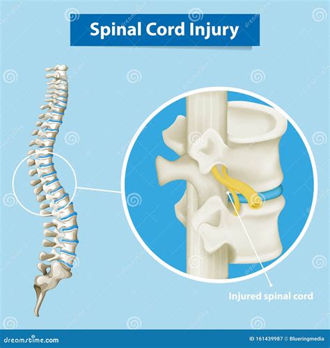 Diagram Showing Spinal Cord Injury Stock Vector - Illustration of cord, living: 161439987