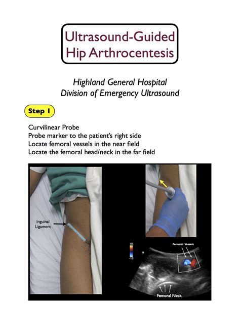 Arthrocentesis: Hip — Highland EM Ultrasound Fueled pain management