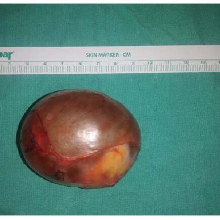 View of an ovarian dermoid cyst during ovary sparing surgery. | Download Scientific Diagram