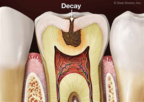 Tooth Decay Prevention | Pediatric Dental Specialists of Atlanta ...