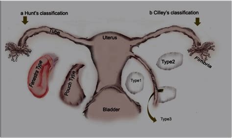 Schematic diagram showing classifications of broad ligament hernia ...