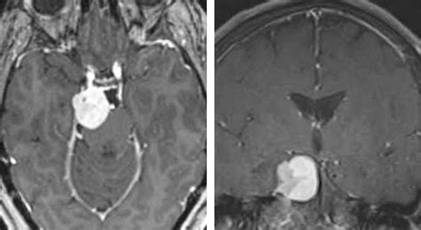 Petroclival Meningioma | Expert Surgeon | Aaron Cohen-Gadol, MD