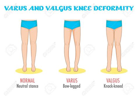 SAMARPAN PHYSIOTHERAPY FITNESS & REHAB. CLINIC: Knee Valgus Deformity : Overview: