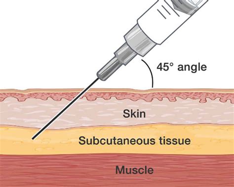 Subcutaneous injection sites, how to give subcutaneous injection & technique