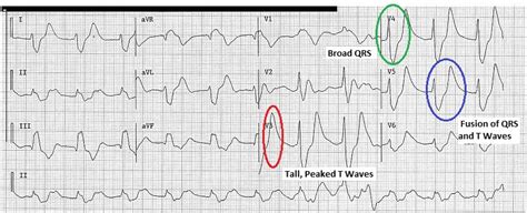 Hyperkalemia electrocardiogram - wikidoc