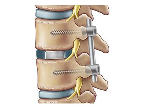 Lumbar Fusion - Affordable brain surgery in México, Puerto Vallarta