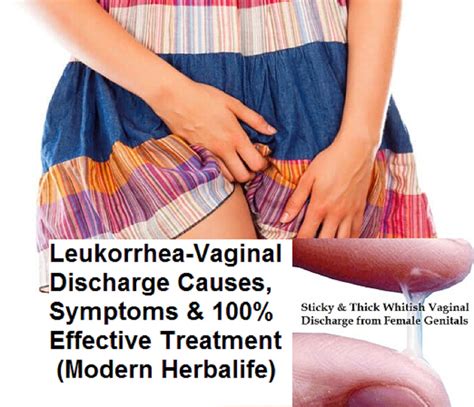 Leukorrhea Causes, Observation & Definition for Treatment of ...