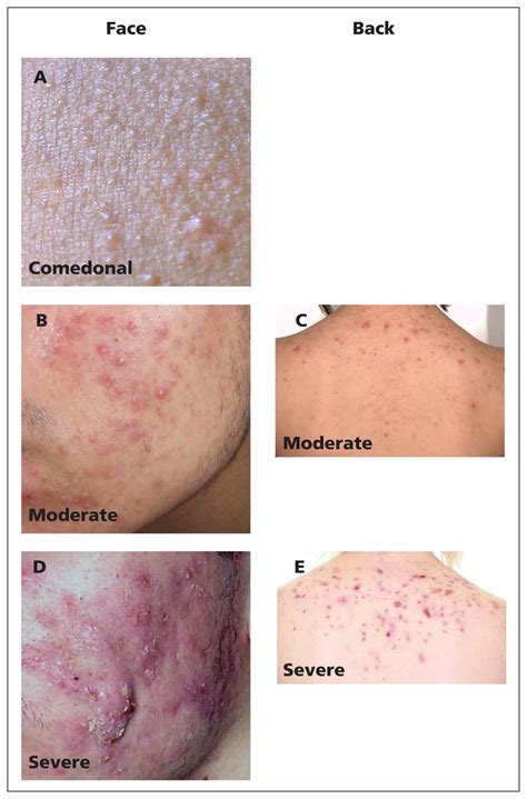 Acne Treatment Guidelines