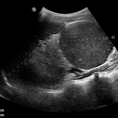 The giant accessory spleen. Ultrasound scan of the splenic area with... | Download Scientific ...