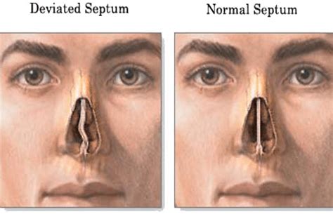 What is a Deviated Septum? Know More about its Surgery and Recovery