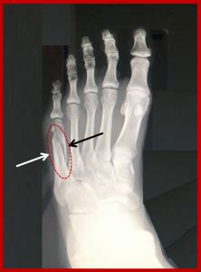 5th Metatarsal Shaft "Dancer's" Fracture - FootEducation