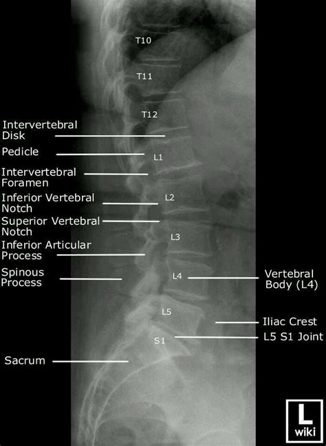 X-ray of the lower back showing vertebrae. Radiology Schools, Radiology Student, Radiology ...