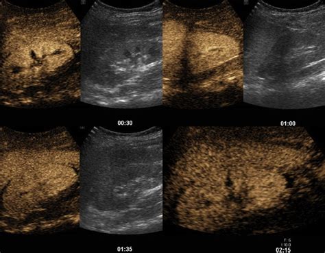 Renal perfusion. Post-contrast-enhanced ultrasound shows prompt ...