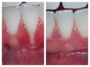 Mucogingival Surgery – Levenson Periodontal Associates