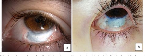 Figure 1 from Donor Cornea Use in Scleral Surface Reconstruction | Semantic Scholar