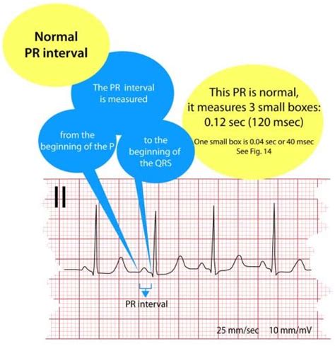 Electrocardiogram, normal PR interval. | Download Scientific Diagram