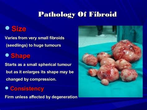 Fibroid for undergraduate