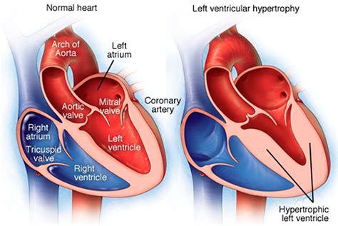 Left Ventricular Hypertrophy - Causes, Symptoms, Diagnosis & Treatment