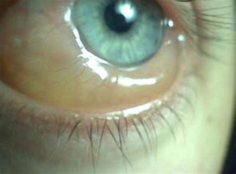 Scleral Edema