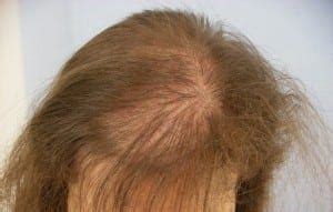 Telogen Effluvium: Hair Loss After WLS (Weight Loss Surgery) - DSSurgery