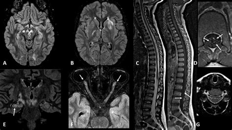 MRI findings of 5-year-old female patient with optic neuritis, combined... | Download Scientific ...