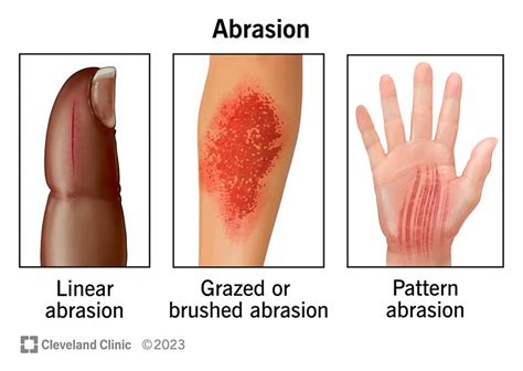 Abrasion (Scrape): How To Treat