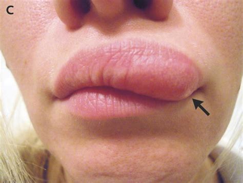 Moving lump in woman's face was a worm, doctors say