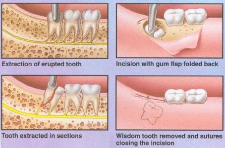 How Are Wisdom Teeth Removed - Elite Dental Care Tracy | Elite Dental Care