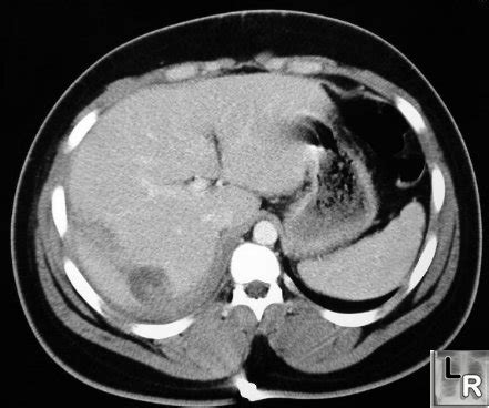 LearningRadiology - Liver Trauma, Hepatic Laceration